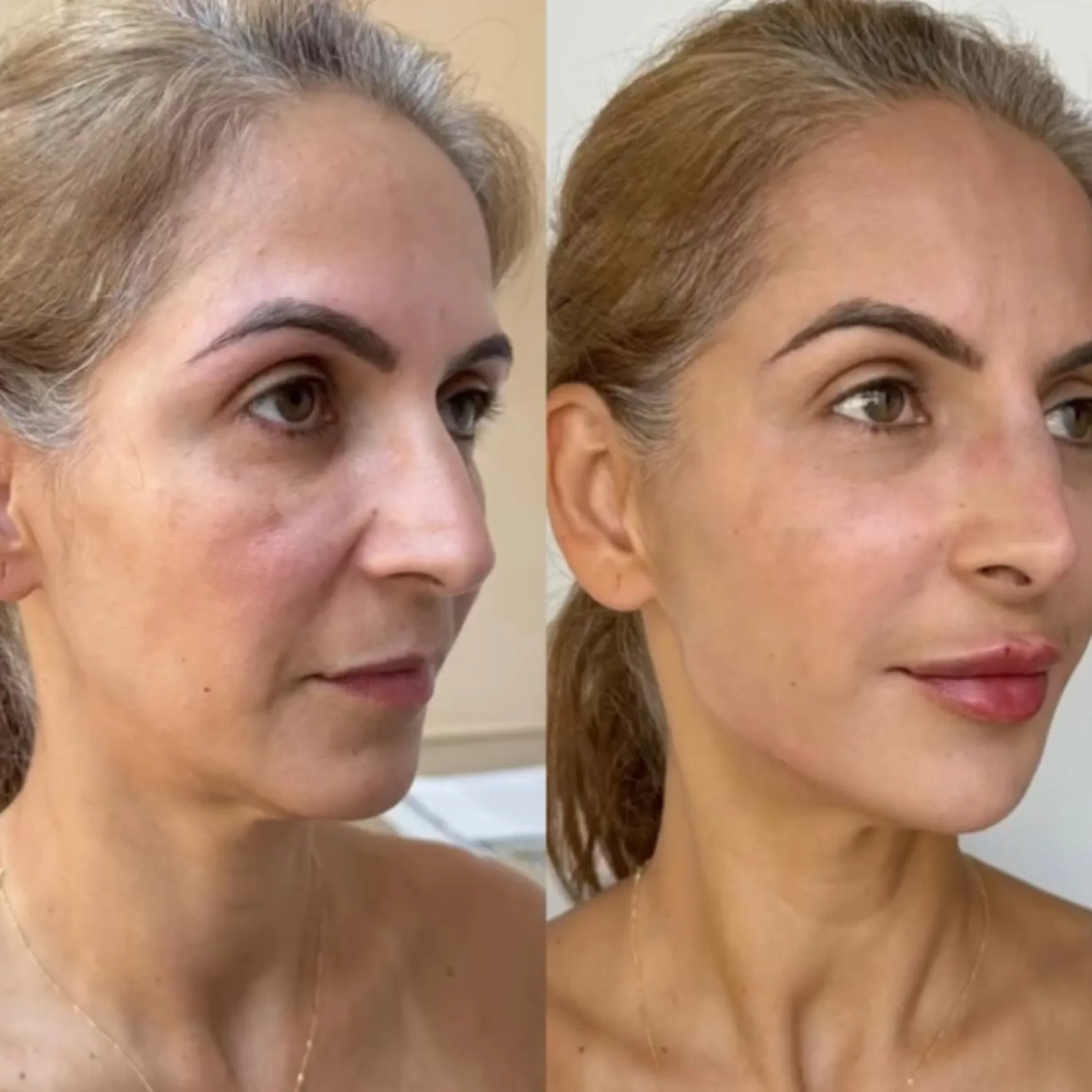 Imagem comparativa de antes e depois 5, em validação