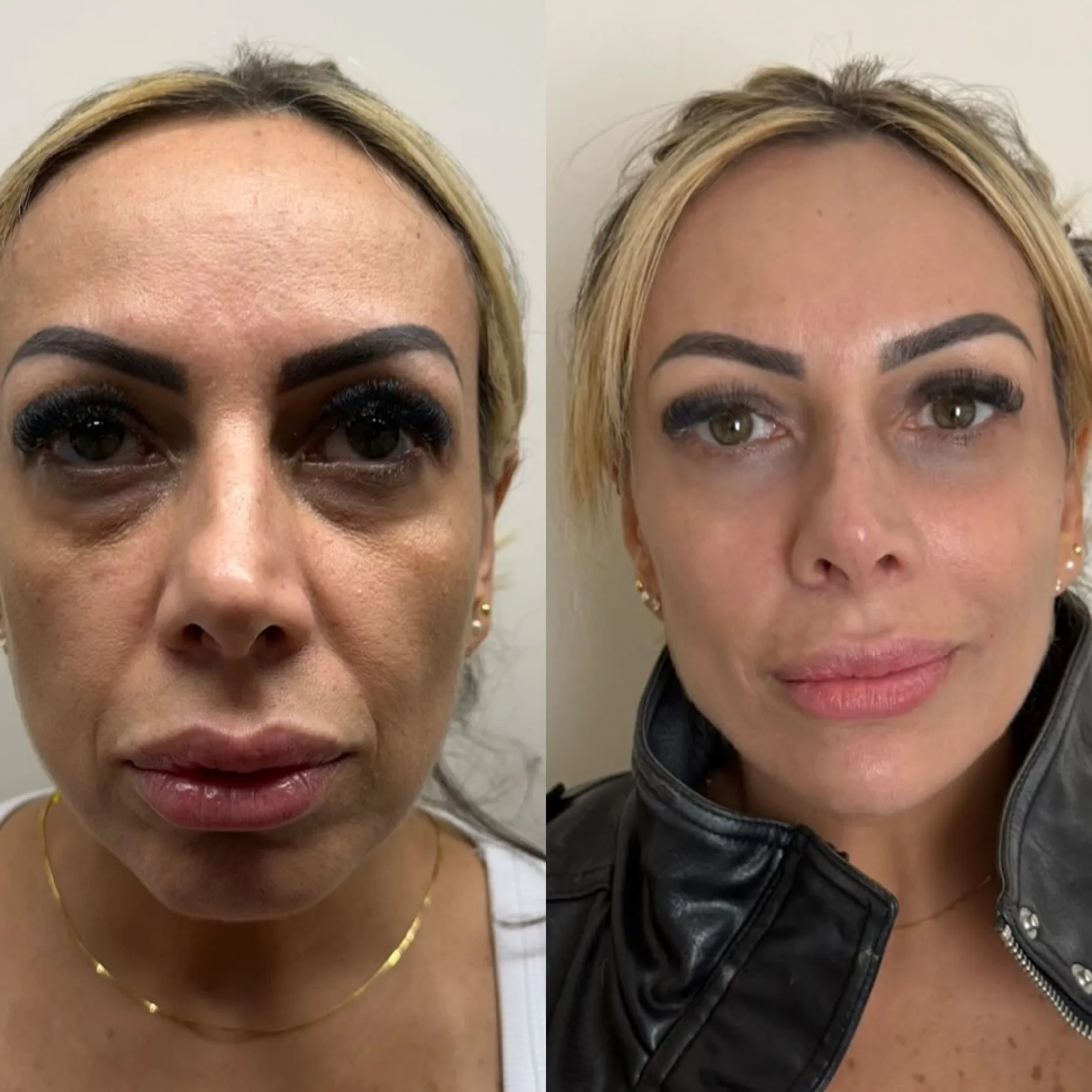 Imagem comparativa de antes e depois 6, em validação