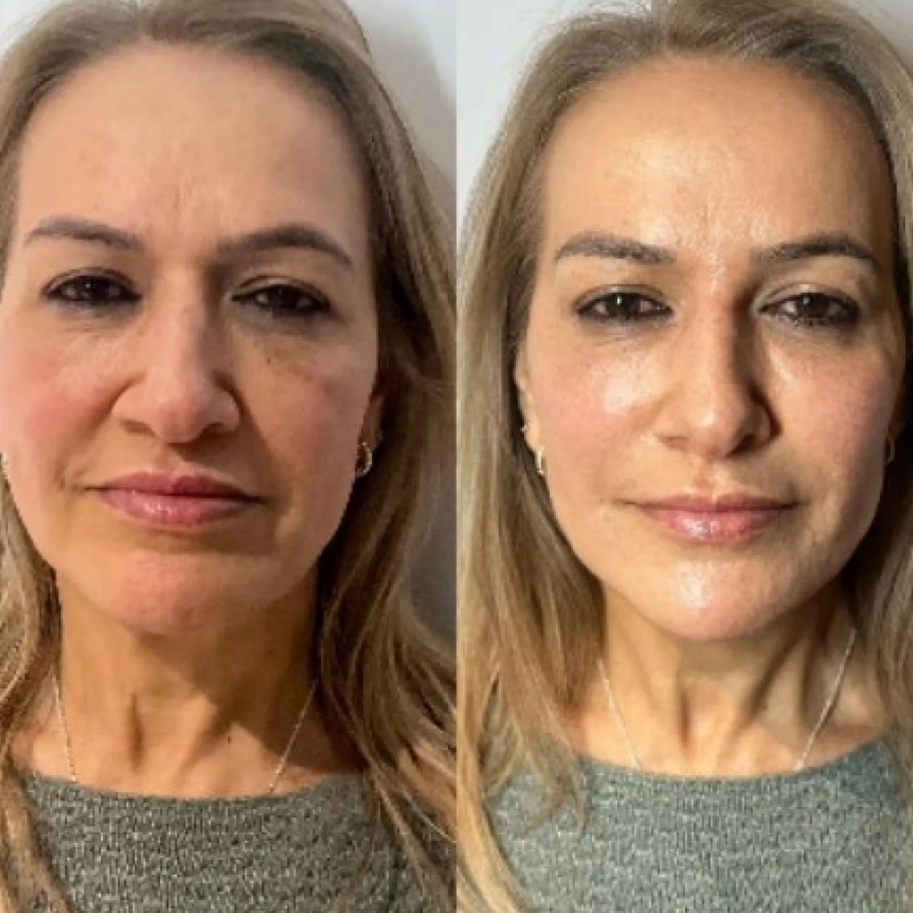 Imagem comparativa de antes e depois 8, em validação